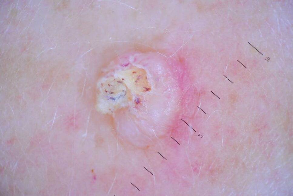 Senatvinės karpos vystymosi stadija – odos ragas