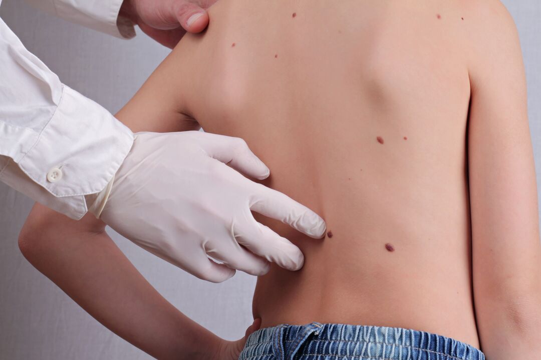 Dermatologas atlieka klinikinį paciento, turinčio papilomų ant kūno, tyrimą