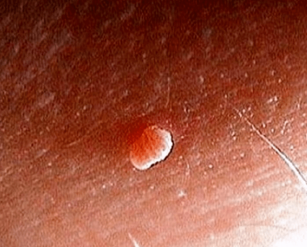 Papiloma ant kūno