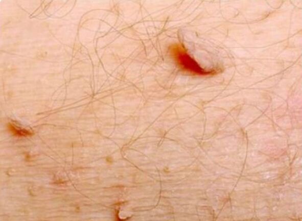 Aštrios papilomos ant žmogaus kūno