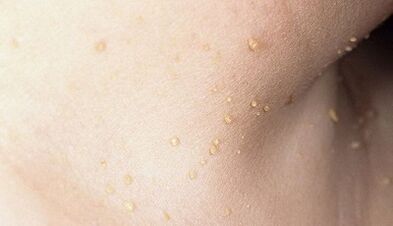 rizika susirgti papilomatoze ant kaklo