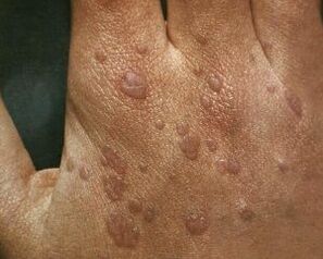 karpų atsiradimo priežastys