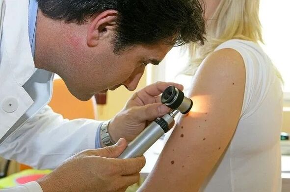 papilomų diagnozė