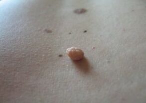 Papiloma yra odos paviršiuje esantis augimas