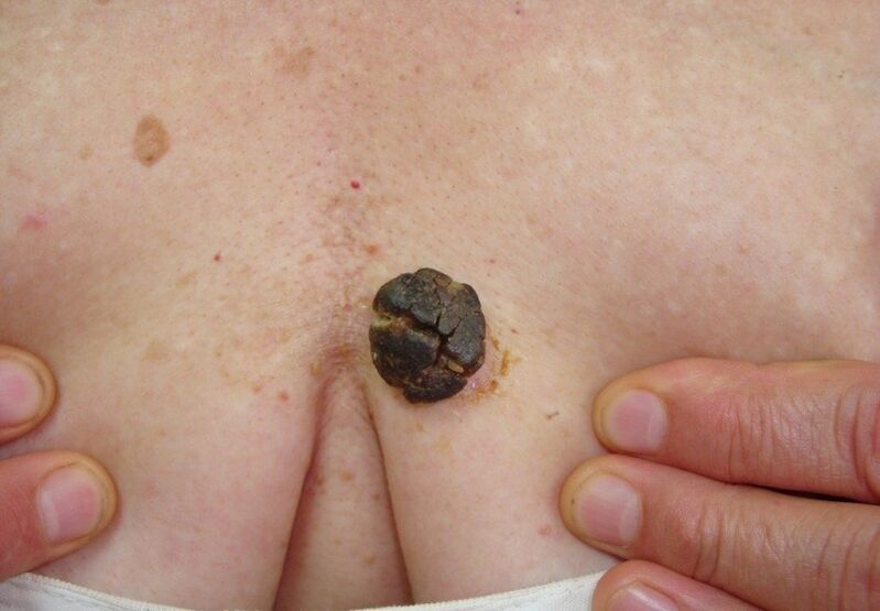 keratoma ant žmogaus kūno